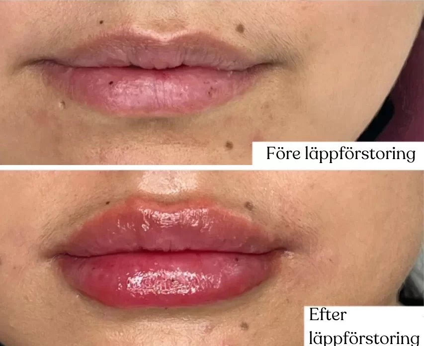 Läppförstoring med fillers, före och efterbild