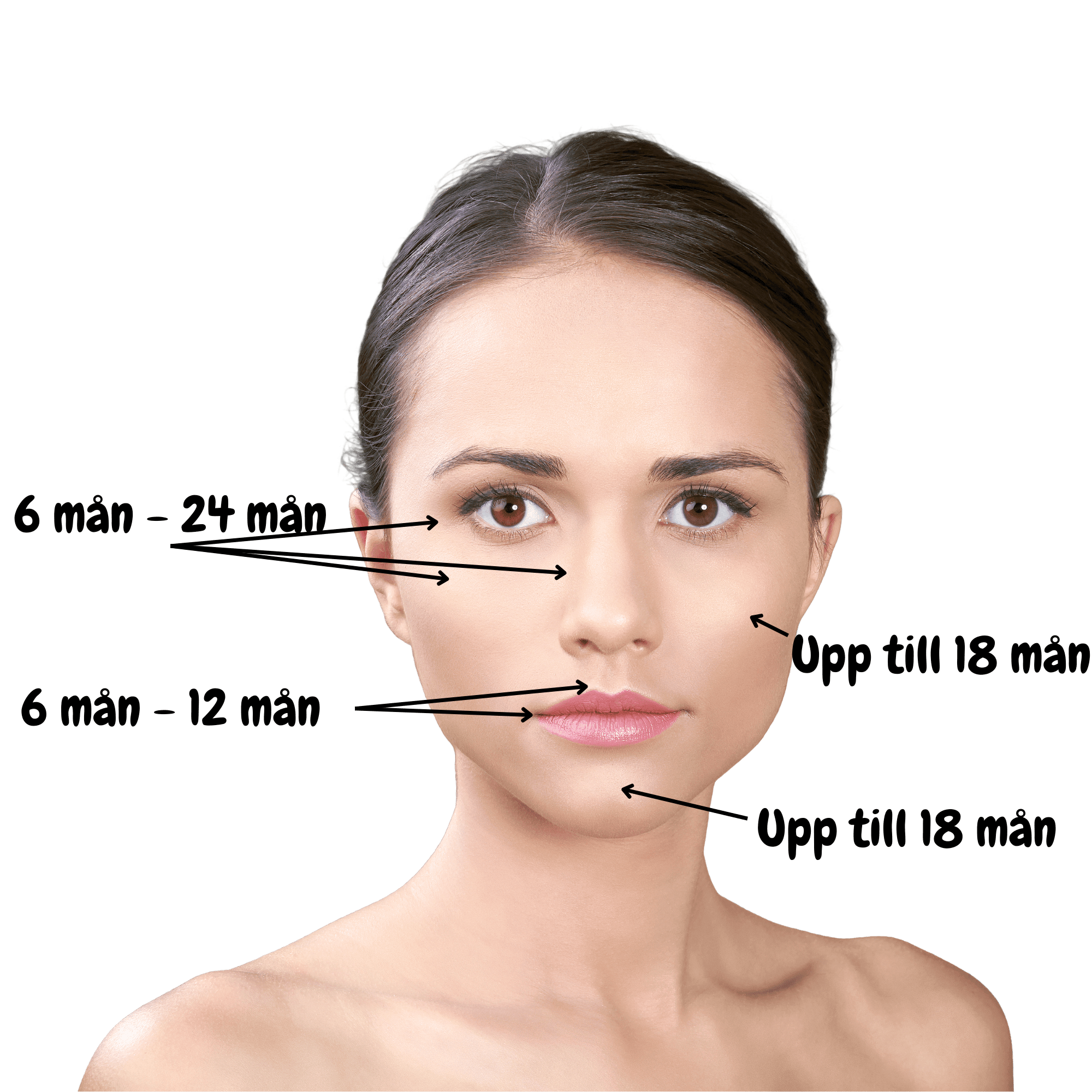 Ansikte med text och pilar, som förklarar hur länge fillers varar för olika områden i ansikte