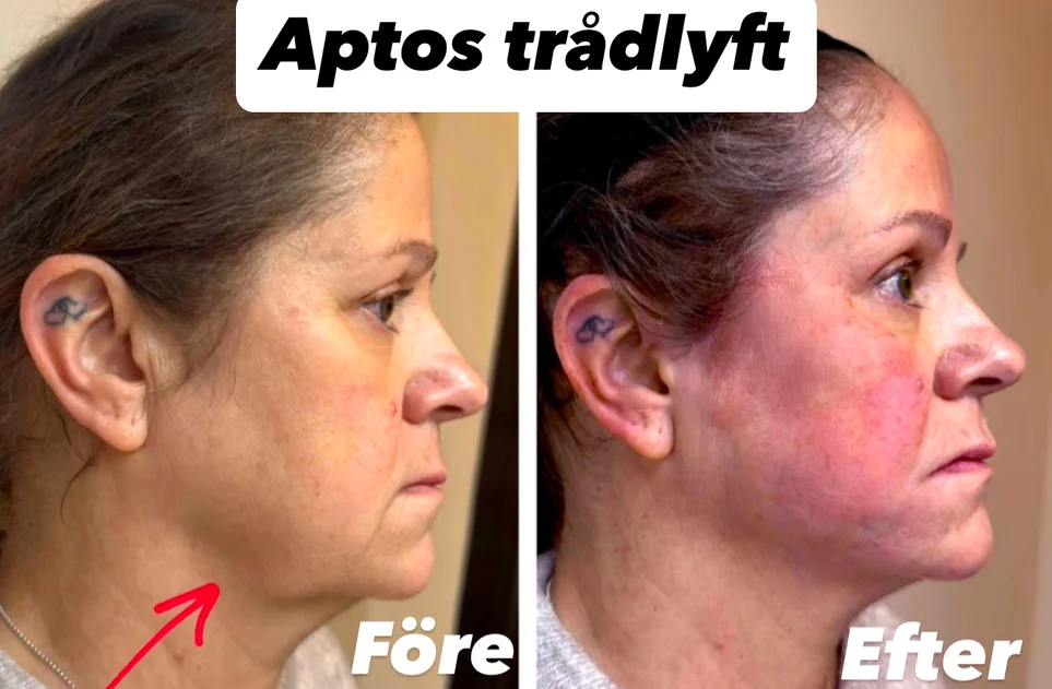 före och efter trådlyft med APTOS, från sidan