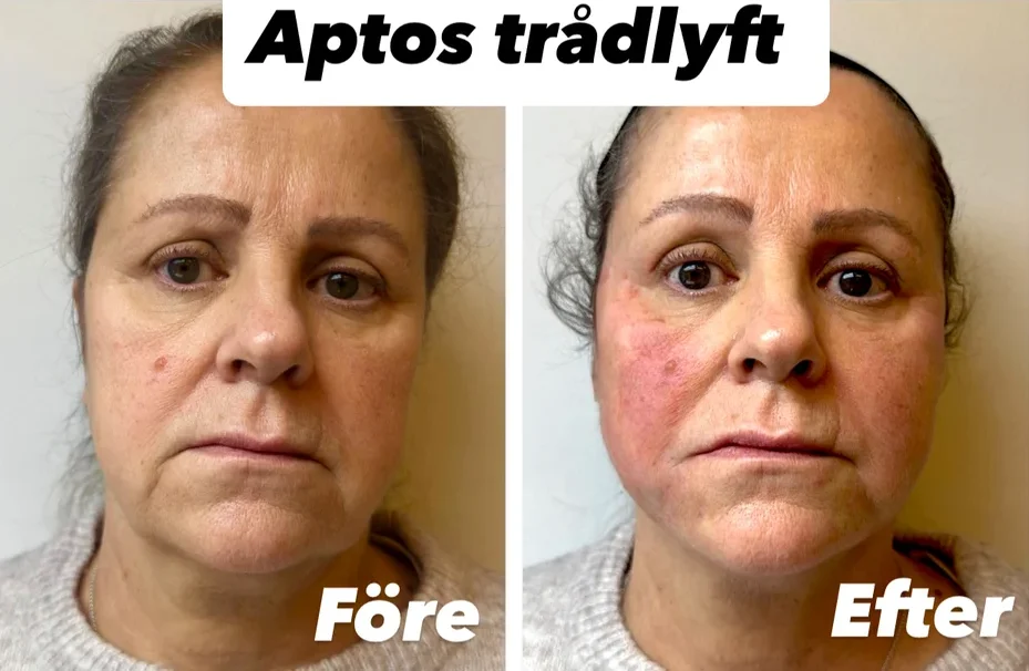 Aptos trådlyft före och efterbild på patient i Stockholm