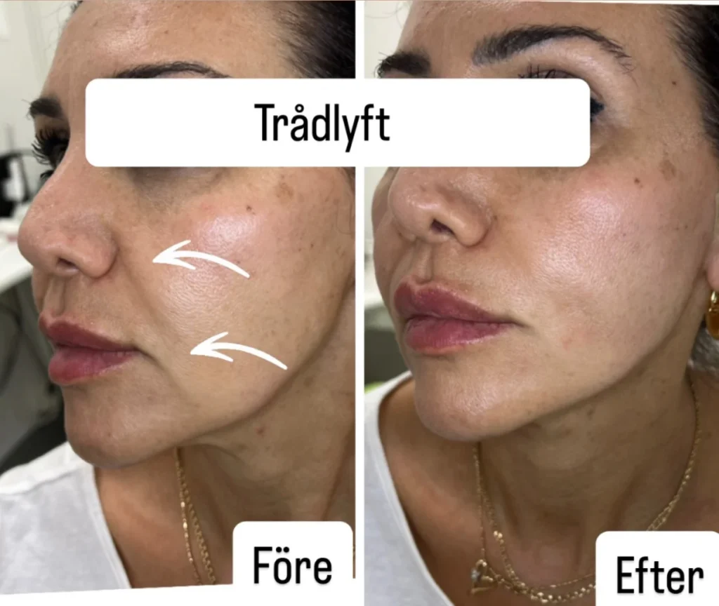 trådlyft före & efter