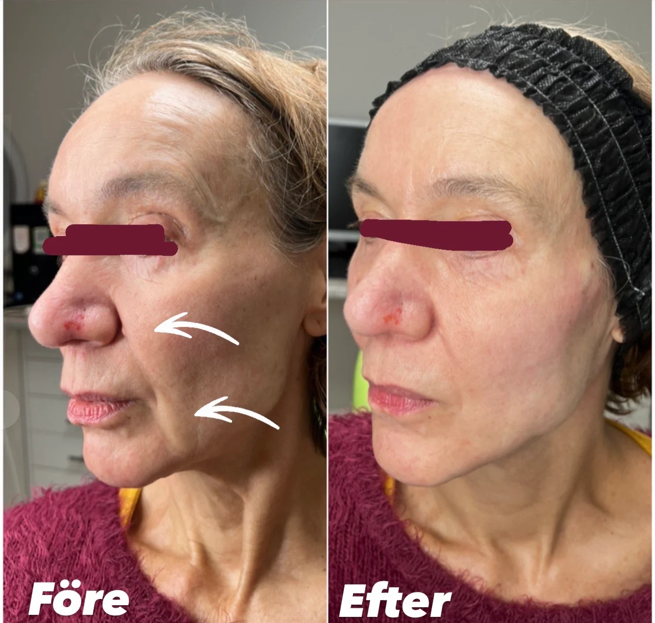 Före och efter APTOS trådlyft på kvinna. Behandling "midface" som lyfter kinderna och ger ett piggare ansiktsuttryck