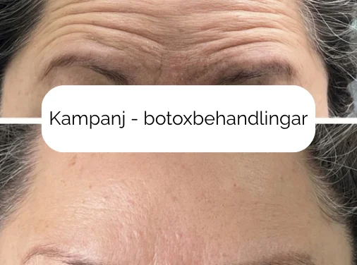 Före & efter botoxbehandling med texten "kampanj botoxbehandlingar i Stockholm"