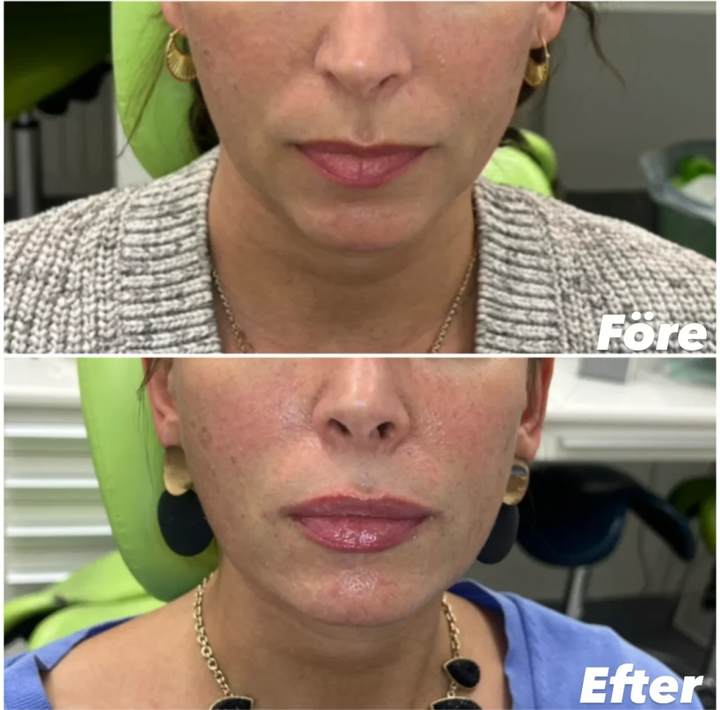 före & efter läppförstoring